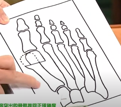 拇趾外翻